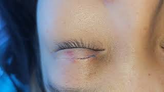 Mini eyelid surgery  4 days ta lang satpa [upl. by Laina703]