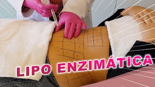 Resultados da Lipo Enzimática  Dr Luciane Bravi Explica [upl. by Heathcote]