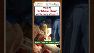 Making “Artificial Bone” 😱 Bone Cancer Treatment  Dr Rajat Gupta bonecancerclinic [upl. by Kalli]