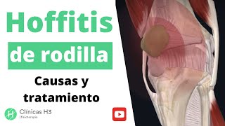 Hoffitis tratamiento con fisioterapia ⏩Hoffitis rodilla tiempo de recuperación  Clínicas H3 [upl. by Anaerda373]