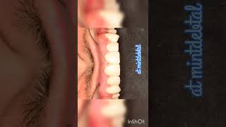 Dental aesthetic treatment FPDprosthodontist bridge [upl. by Eissirhc]