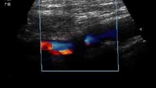 INTERNAL CAROTID ARTERY UNSTABLE PLAQUE quotAT RISKquot [upl. by Niai787]