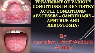 11Treatment of various conditions in dentistry acute overgrowth candida ulcers–Wadhah lectures [upl. by Abernathy]