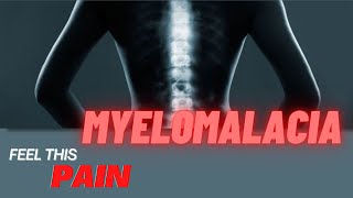 Feel This Pain S3E3 Myelomalacia [upl. by Mlawsky435]