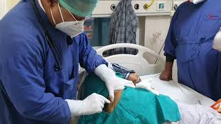 Bone Marrow Aspiration and Biopsy Dr Sandeep Kumar garg Nutema Hospital [upl. by Tenom980]