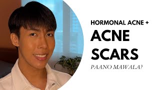 Paano mawala ang Hormonal Acne at Acne Scars Based on my PERSONAL EXPERIENCE [upl. by Ingmar]