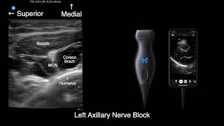 US anatomy for axillary nerve block with ButterflyIQ [upl. by Bultman]