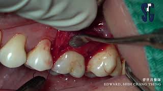 Technique to debridement with furcation [upl. by Lletnom143]