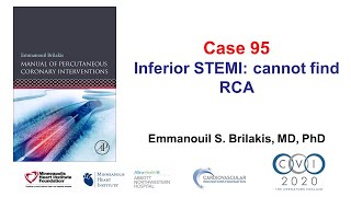 Case 95 PCI Manual  STEMI and unable to engage [upl. by Alioz]