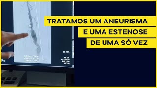 Tratamento de paciente com aneurisma poplíteo e estenose femoral [upl. by Asenab859]