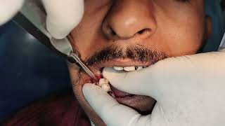 Fast and painless removal of Root stump of grossly decayed molar tooth [upl. by Lamrej828]