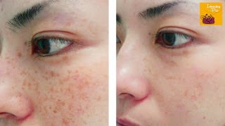 Amazing Freckles Removing Homemade Solution  100 Results [upl. by Idyak2]