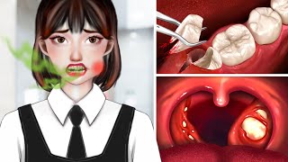 ASMR Dental Cleaning Procedures  Tonsil Stones Removal [upl. by Oniliuqnart]