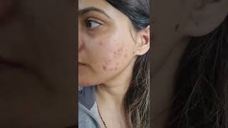 My acne recovery journey  treatment [upl. by Leotie]