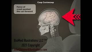 Coup Contrecoup Whiplash Brain Injury [upl. by Fabio]