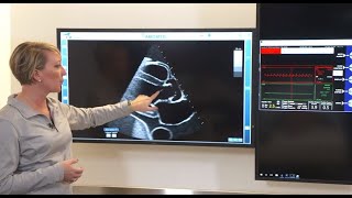 Managing Impella Position Using Imaging [upl. by Cuyler22]