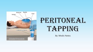 Houseman preparation procedures Peritoneal tapping Paracentesis  procedural steps [upl. by Itnaihc]