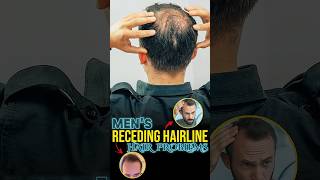 Hair Loss Receding Hairline Treatment [upl. by Whitford]