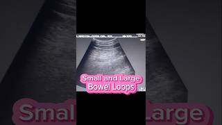 Prominent Bowel Loops  Enteritis  Colitis  Bowel Obstruction on Ultrasound [upl. by Yahs]