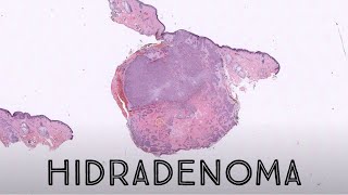 Hidradenoma Acrospiroma pathology dermatology dermatopathology skin adnexal sweat gland tumor [upl. by Napoleon]