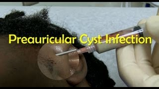 Preauricular Cyst Infection Management [upl. by Sasnett]