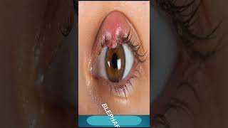 Blepharitis Treatment  Which Medicine Use In Blepharitis [upl. by Salangia]