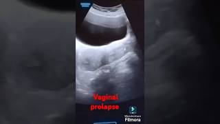 VAGINAL PROLAPSE usg UTERUSRADIOLOGY [upl. by Annerol631]