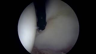 Debridement of Hyperplastic Labrum Prior to Surgical Repair [upl. by Anirbes675]