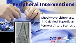 Shockwave Lithoplasty in Calcified Superficial Femoral Artery Stenosis – October 25 2017 [upl. by Lamrouex]