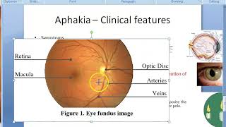 Ophthalmology 047 b Aphakia Clinical features [upl. by Ahtaela]