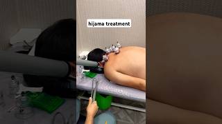 hijama treatment [upl. by Adnaram]