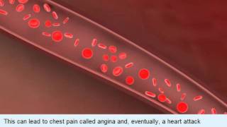 動脈粥樣硬化 Atherosclerosis [upl. by Cherida]