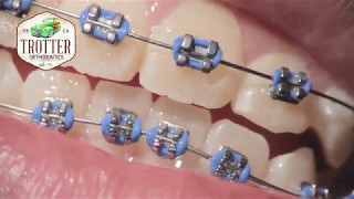 Watch How Braces Are Put On  Orthodontic Treatment Using Fixed Brackets Redondo Beach Orthodontist [upl. by Dionysus]