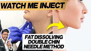 Fat Dissolving Injections For Double Chin Needle HowTo [upl. by Annayi]