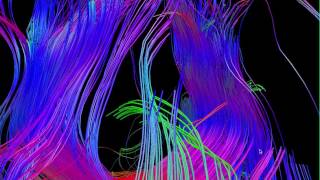 Diffusion Tensor Tractography DTI MRI 5  William Edward Hahn [upl. by Gabriela]