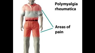 Polymyalgia Rheumatica [upl. by Anerev996]