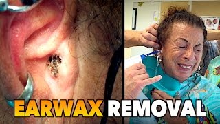 MASSIVE EARWAX REMOVAL  Dr Paul feat Maiya [upl. by Raimondo595]