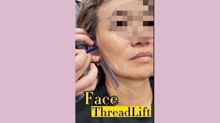 Transform Your Look with a Face Thread Lift Before and After Video [upl. by Nibaj679]