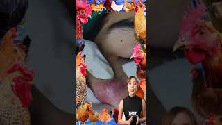 Blackheads Removal  Acne Treatment and Very Satisfying Satisfying Pimple pop blackheads [upl. by Eveam]