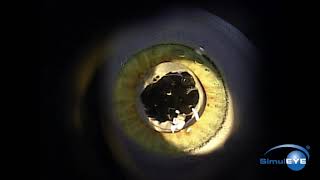 SimulEYE YAG Capsulotomy [upl. by Adnarem]