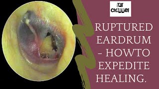 Ruptured eardrum I what should you do after traumatic perforation of tympanic membrane [upl. by Roger]