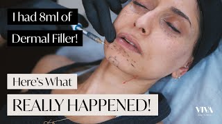 Full Face Dermal Filler 😱 Heres what REALLY happened 2021 [upl. by Magena]