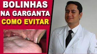 BOLINHAS NA GARGANTA COMO EVITAR O CASEUM DAS AMÍGDALAS [upl. by Nastassia300]