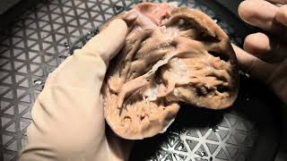 Specimen walkthrough 10 Atrial septal defect [upl. by Naujled879]