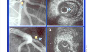 Background Epidemiology and Causation of CAD [upl. by Ykcor127]