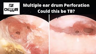 3 Common Causes of Multiple Eardrum Perforation [upl. by Iinde]