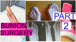 BUNION SURGERY PART 2  STORYTIME  Grace Jennings [upl. by Loresz]