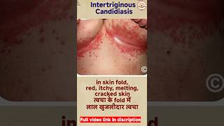 candidiasis  fungal skin infection  oral thrush shorts reels [upl. by Cobbie913]