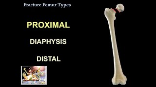 Fracture Femur Types  Everything You Need To Know  Dr Nabil Ebraheim [upl. by Nali]