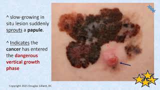 Dermatology wk6spr21 Malignant melanoma [upl. by Salchunas]